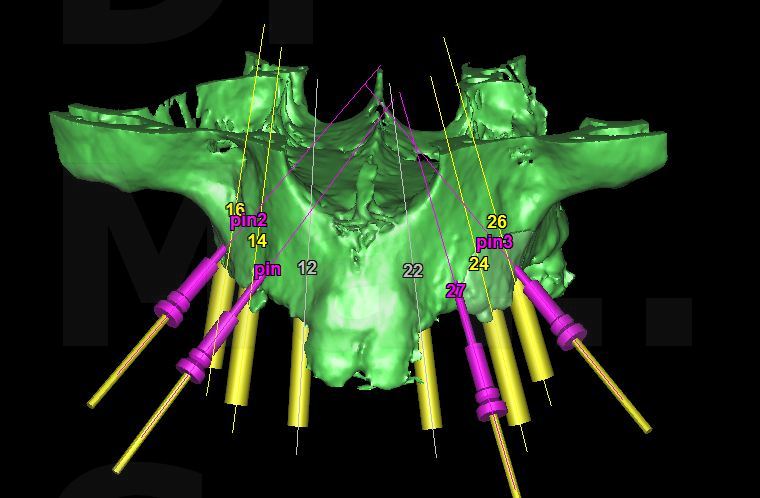 radiologia olbia tac cone beam chirurgia implantologia guidata olbia
