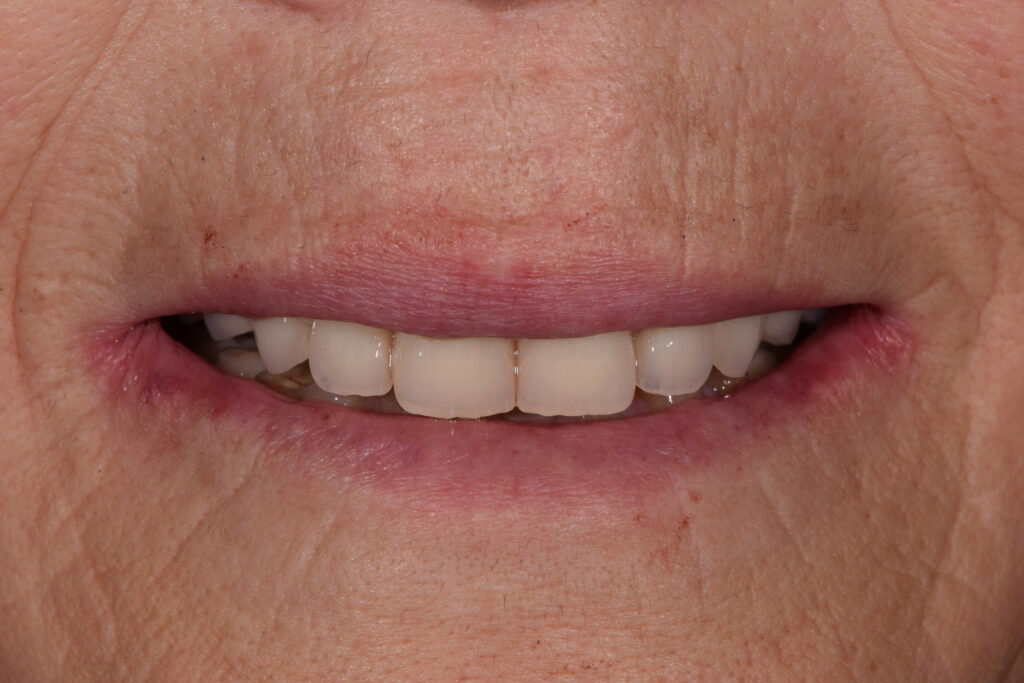 implantologia a carico immediato denti fissi in 24h dentista olbia studio dentistico
