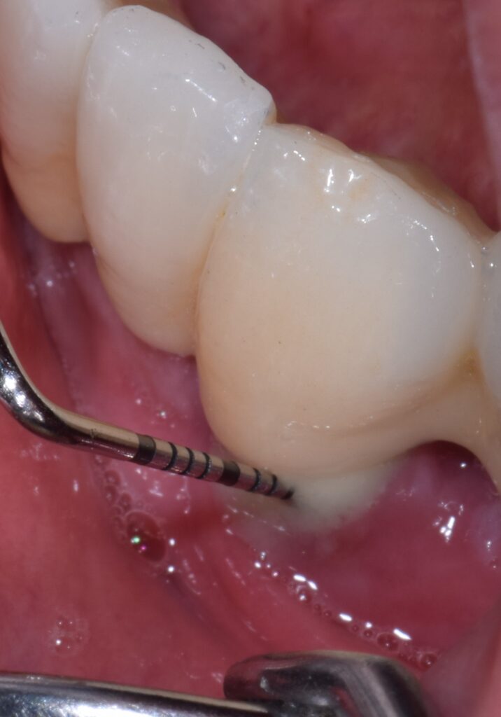 piorrea gengive infiammate pus parodontologo dentista olbia studio dentistico