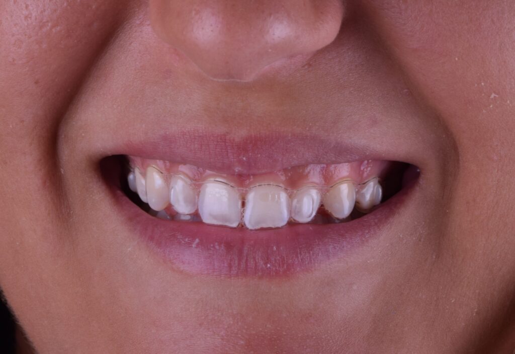 ortodonzia invisibile allineatori invisalign dentista olbia studio dentistico