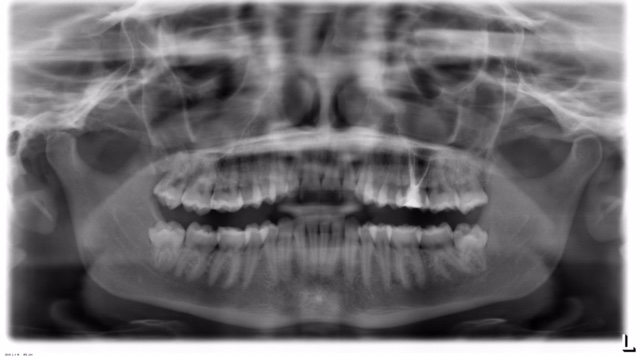 estrazione denti del giudizio olbia marco sanciu dentista